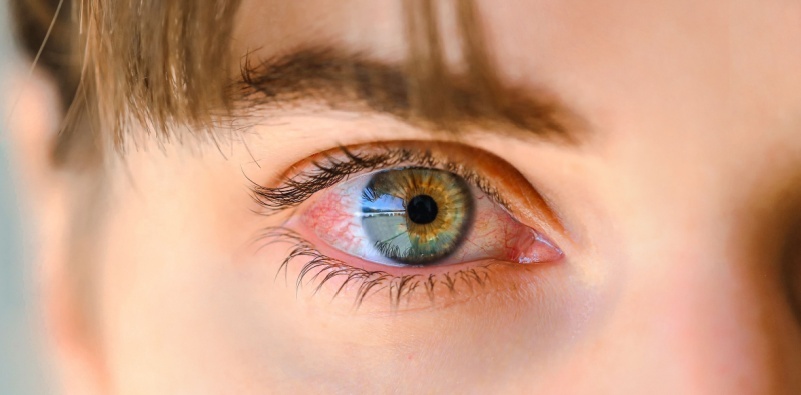 Dry eye symptoms